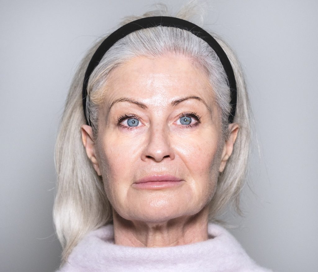botox - full face after