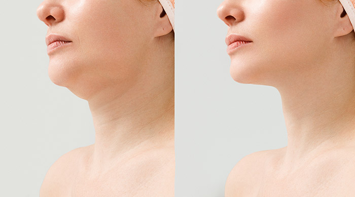 Before and after split-image showcasing the remarkable improvement in a woman's neck area, illustrating the effective results of Profhilo treatment.