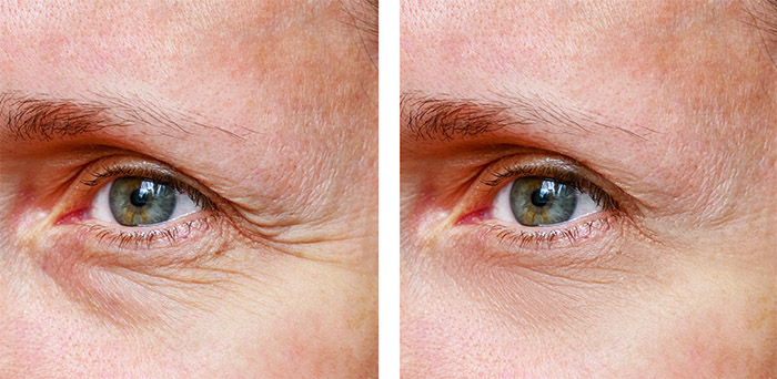 Profhilo eyes before and after treatment compared
