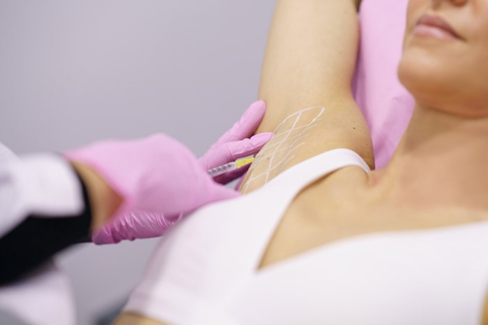 Doctor marking injection sites under a woman's arm for Botox treatment, syringe in hand